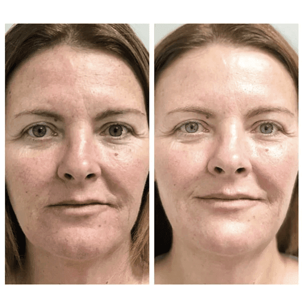 Hydrodermabrasion