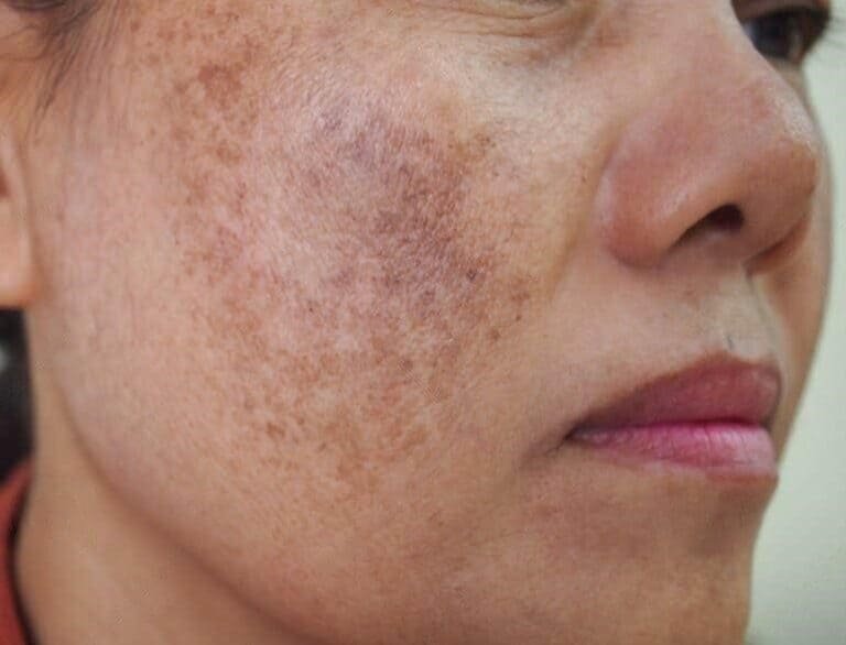 MELASMA