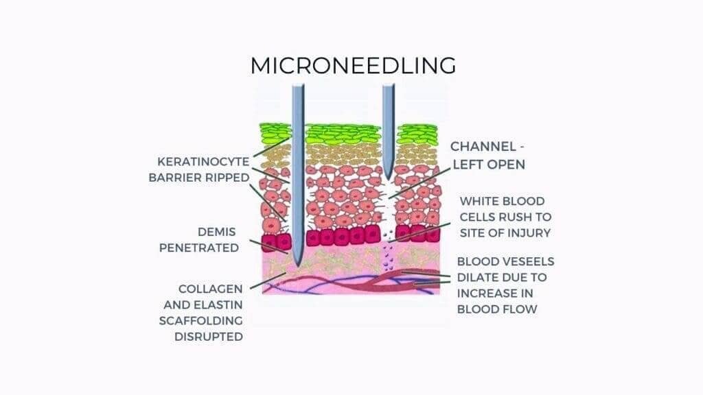 Micro needling