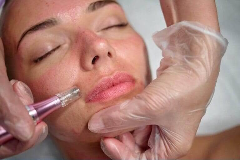 Micro needling