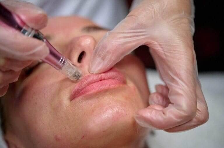 Micro needling