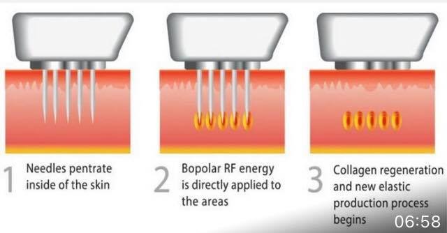 RF needling