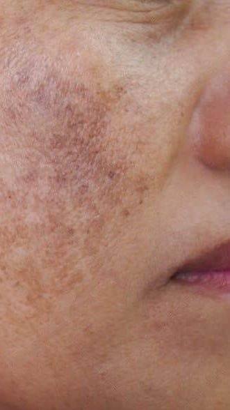 Melasma