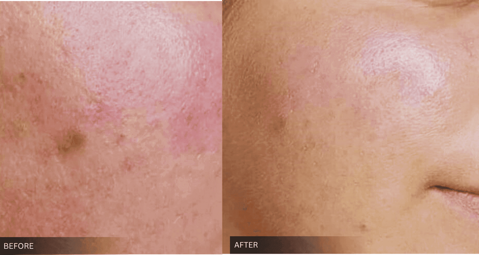 Laser pigmentation