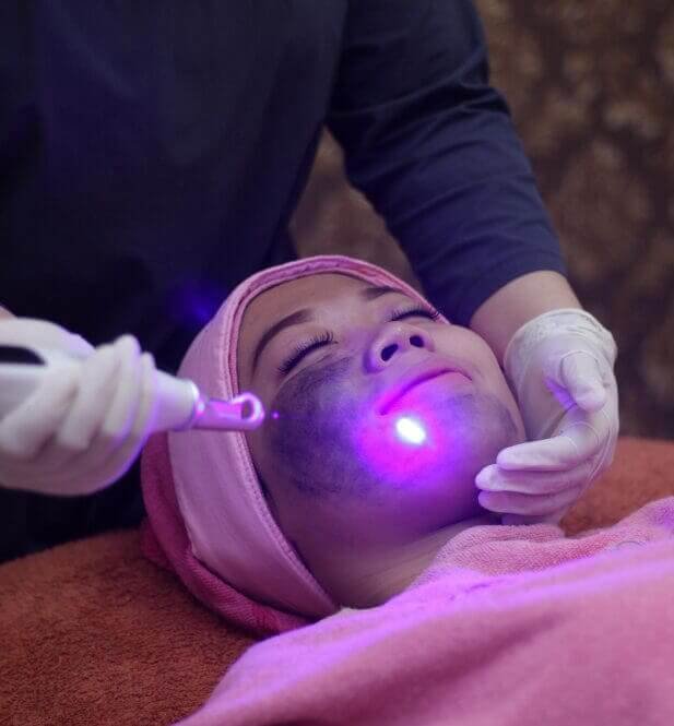 Laser Pigmentation