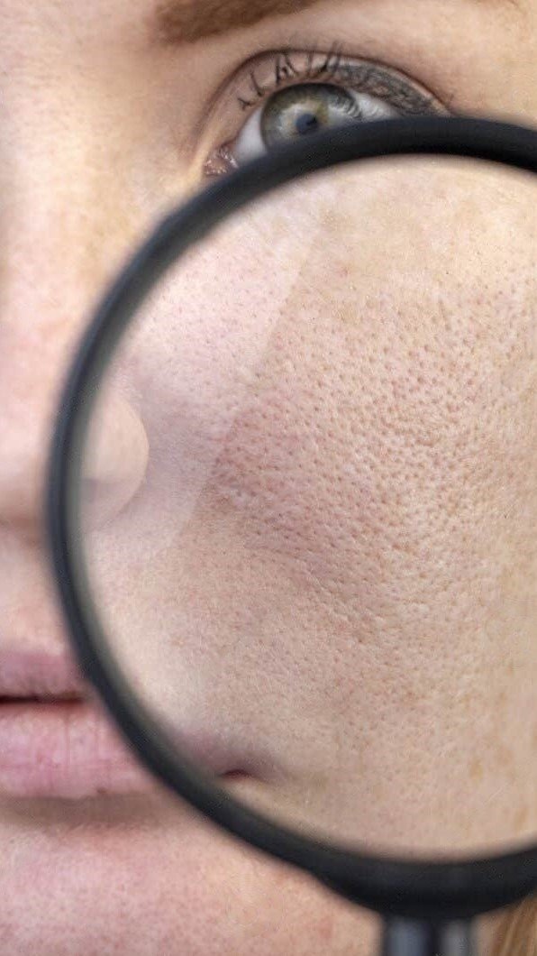 enlarged pores