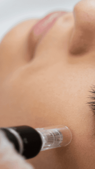 Microneedling