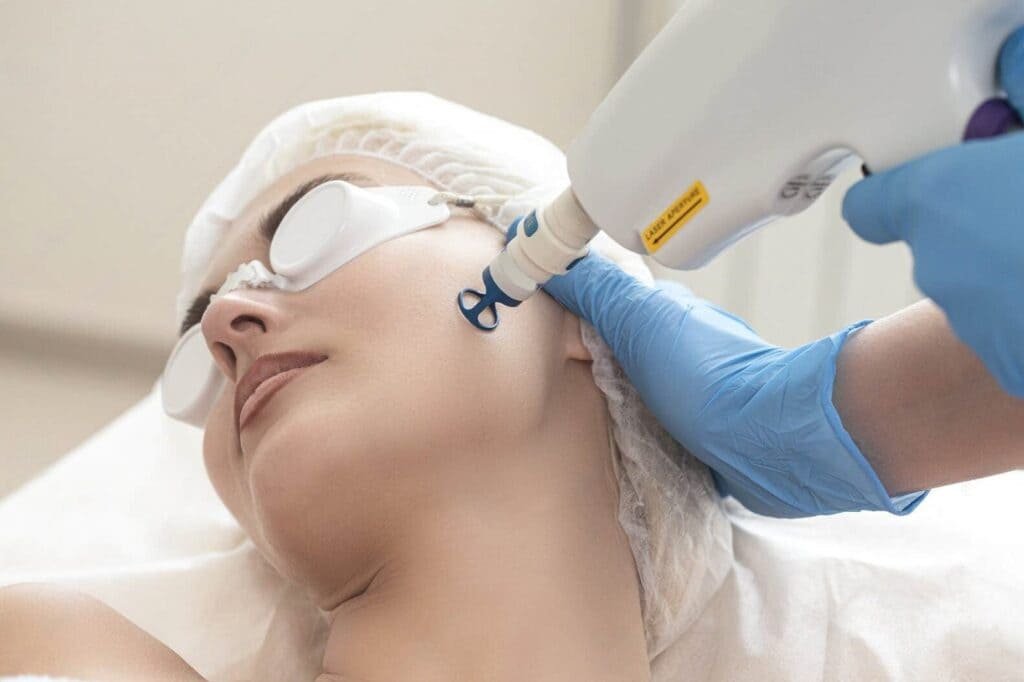 laser-pigmentation-removal